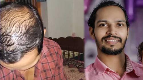 മുടികൊഴിച്ചിലിൽ മനംനൊന്ത് യുവാവ് ആത്മഹത്യ ചെയ്തതായി റിപ്പോർട്ട് മുടികൊഴിച്ചിലിൽ മനംനൊന്ത് യുവാവ് ആത്മഹത്യ ചെയ്തതായി റിപ്പോർട്ട്