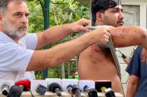 'പെല്ലറ്റുകൾ ഉപയോഗിച്ചിട്ടില്ലെന്ന വാദം കള്ളം': പരിക്കേറ്റ വിദ്യാർത്ഥിയുമായി രാഹുൽ ഗാന്ധി മാധ്യമങ്ങൾക്ക് മുന്നിൽ