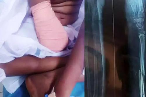ഒമ്പതു വയസ്സുകാരിയുടെ കൈ മുറിച്ച സംഭവം; ആവശ്യമായ ശാസ്ത്രീയ ചികിത്സ നൽകിയിരുന്നുവെന്ന് ആവർത്തിച്ച് അന്വേഷണ റിപ്പോർട്ട്