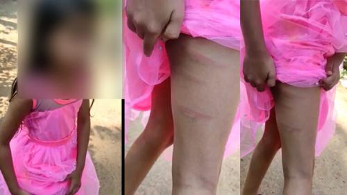 ഖുർആൻ മനഃപാഠമാക്കിയില്ല; മലപ്പുറത്ത് എട്ട് വയസ്സുകാരിക്ക് മദ്രസ അദ്ധ്യാപകന്റെ ക്രൂര മർദ്ദനം ഖുർആൻ മനഃപാഠമാക്കിയില്ല; മലപ്പുറത്ത് എട്ട് വയസ്സുകാരിക്ക് മദ്രസ അദ്ധ്യാപകന്റെ ക്രൂര മർദ്ദനം