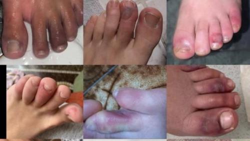 എന്താണ് കൊവിഡ് ടോസ് ?