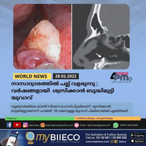നാസാദ്വാരത്തിൽ പല്ല് വളരുന്നു ; വർഷങ്ങളായി ശ്വസിക്കാൻ ബുദ്ധിമുട്ടി യുവാവ്