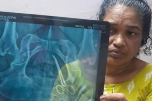 ആലപ്പുഴ മെഡിക്കൽ കോളജിൽ അഞ്ചു വർഷം മുൻപ് ശസ്ത്രക്രിയയ്ക്കിടെ വയറ്റിൽ കത്രിക കുടുങ്ങിയ സംഭവത്തിൽ ഡോക്ടറെ പ്രതി ചേർക്കും